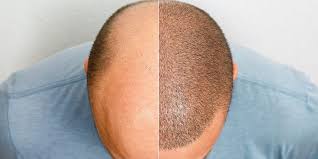 Schedule Your Hair Transplant Consultation in Islamabad Today