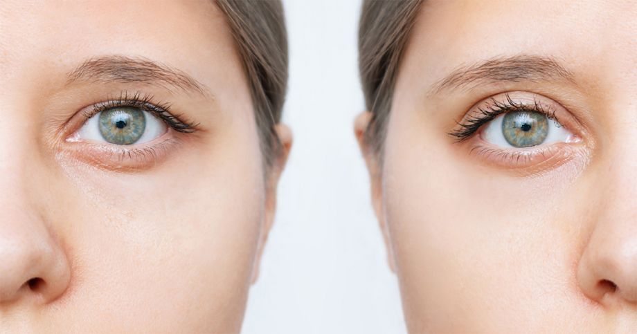 Price Comparison for Eyelid Surgery in Islamabad